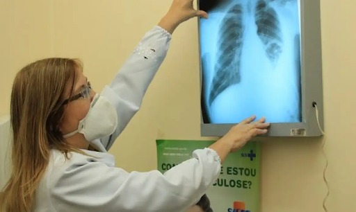 Casos de tuberculose caem 35% no RN, aponta Sesap