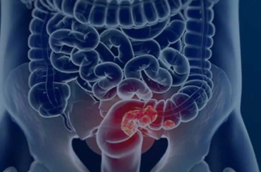  Pacientes com câncer colorretal são diagnosticados em estágio avançado