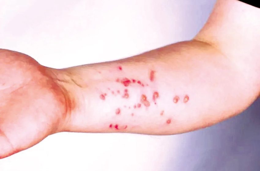  Secretaria de Saúde descarta caso de monkeypox em paciente potiguar