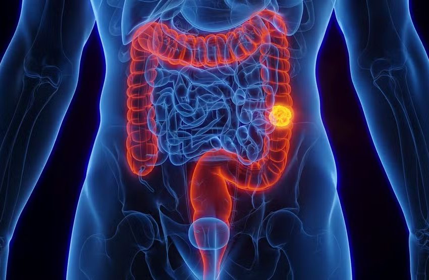  SUS adota novo exame para detectar câncer de intestino antes de sintomas