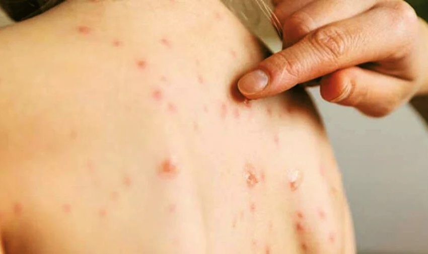  Índice de vacinação contra o sarampo preocupa o RN
